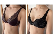 美バストアルファ(美bust α)/【バストアップ】症例