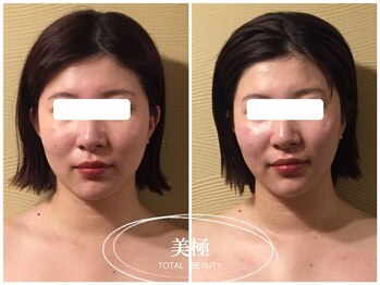 美極 銀座店/銀座/小顔コルギ/小顔矯正