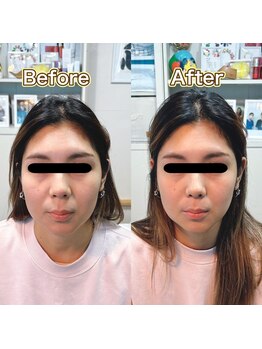 代々木美容鍼灸サロン さくら/美容鍼　before　after