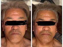 シャイニーシャイニー 金沢店(SHINY/SHINY)/小顔フェイシャル症例