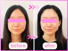 ホリハ整体院/*Before&After* 幹細胞美容鍼