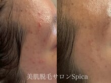 スピカ(SPICA)/効果パウダーで効果大！