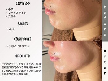 ルディラ医療提携エステ 立川店 毛穴/小顔/ニキビ・シミ・美白・シワ・たるみケア/小顔バイオリフト