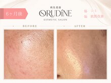 オルディーネ(ORUDiNE)/シワ改善ハリ肌