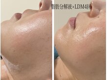 グラン ジュテの雰囲気（大豆脂肪分解液リポベラ×LDMで美肌＆小顔に）