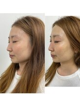 ナノハナ/鹿沼市の全身脱毛美容室ナノハナ