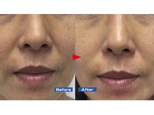 ニュイブラーシュ(nuit blanche)/実は目立ってきた法令線にも♪