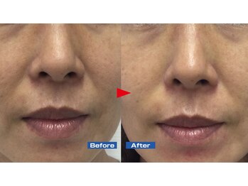 ニュイブラーシュ(nuit blanche)/実は目立ってきた法令線にも♪