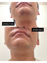 リル(Lil)/1ヶ月半でこの変化！