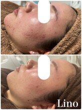 リノ(Lino)/美肌はコツコツと♪