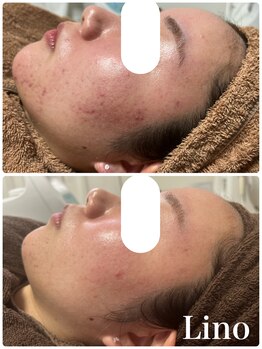 リノ(Lino)/美肌はコツコツと♪