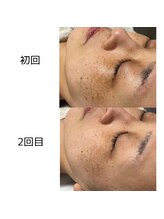 ルアラナ(Lualana)/マリンピーリング☆ハーブリプロ