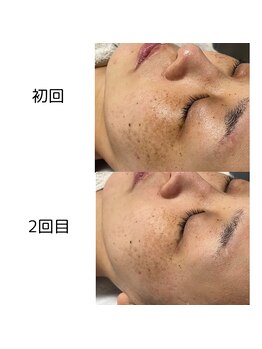 ルアラナ(Lualana)/マリンピーリング☆ハーブリプロ