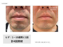 フェレザ 新潟(Felleza)/ヒゲの悩みを脱毛で解決