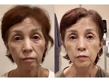 ユー 喜連西店(U)/美容鍼