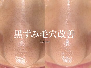 ラティエ(Latier)/黒ずみ毛穴ケアハーブピーリング