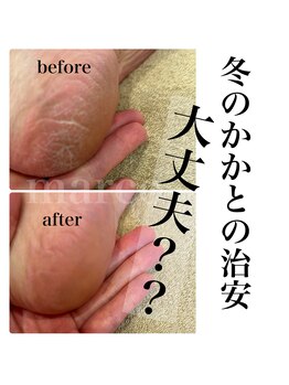 マルコ(marco)/かかと角質ケア