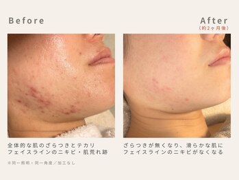 メレ(mele)/20代赤み/ニキビケア・毛穴