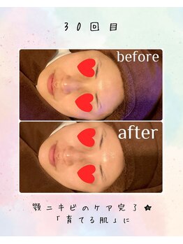 リリアン(lirien)/毛穴/毛穴ケア/毛穴洗浄/駒込