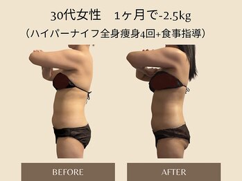 オベリオ(OBERIO)/ハイパーナイフ全身痩身