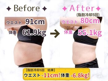 イワサキ(IWASAKI)の写真/腰回りの脂肪にさようなら！凍らせて痩せる新習慣、津市に登場♪脂肪冷却マシンで理想のボディラインを☆