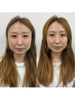 ナノハナ/鹿沼市の全身脱毛美容室ナノハナ