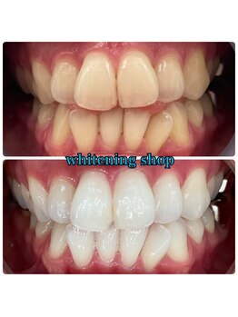 ホワイトニングショップ 大阪玉造店/Before&After美白ホワイトニング