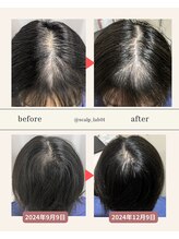 スカルプラボ 倉敷店(Scalp Lab)/moumitu3ヶ月症例