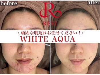 ホワイトアクア 四日市店(WHITE AQUA)/四日市ハーブピーリング