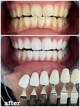 エクシアホワイトニング 札幌中島公園店/Before After［ホワイトニング］