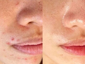 ラエッセ 目黒 白金台店(LAESSE)/毛穴・美白専門店 LAESSE 白金台