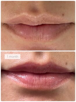 OBS新潟整骨院/ローマピンク途中経過