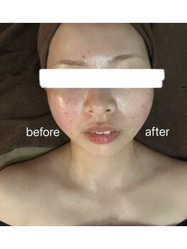 ウィズサロン(withサロン)/ララピーリング+レモンボトル