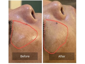 アスボーテ 月島(As Beaute’)/水光肌Specialコース1度の変化♪