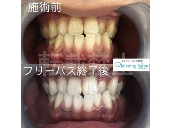 ホワイトニングサロン 福岡天神店/ホワイトニング