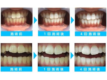 リボーン(REBORN)の写真/遂に導入！一生使う歯のことを最大限に考えた結果重視のホワイトニング！丁寧な説明カウンセリングで安心◎