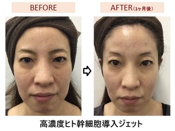 リボディエステアンド整体(Rebody)/ヒト幹細胞高圧ジェット導入