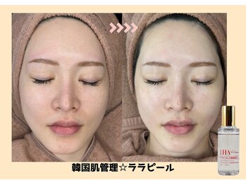 バベルトータルビューティー 北堀江店(Babel Total Beauty)/第4世代【ララピール】