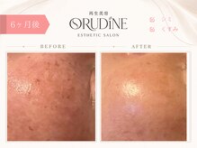オルディーネ(ORUDiNE)/ シミケア透明感