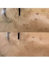 ピアーノ(PIANO)/エルモサハーブピーリング