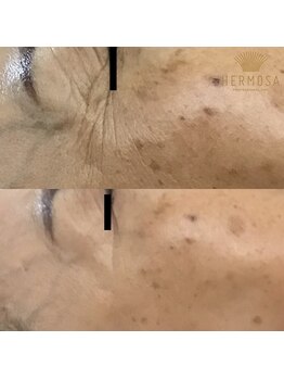 ピアーノ(PIANO)/エルモサハーブピーリング