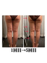 スターエステ(STAR ESTHE)/下半身1回目→5回目