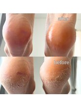 フットミー(foot mii)/施術1回での変化写真です