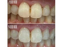 エピシアドットエヌ(epicia.N)/ホワイトニング
