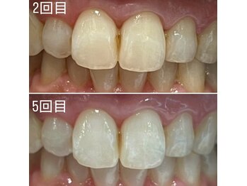 エピシアドットエヌ(epicia.N)/ホワイトニング