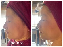 ルー ハナレ 神戸岡本 摂津本山店(Luu HANARE)/フェイスライン小顔　４回