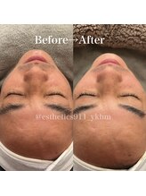 エステティックス ナインワンワン 横浜(Esthetics911) /くすみ黒ずみも1回で劇的変化！