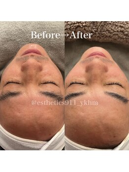 エステティックス ナインワンワン 横浜(Esthetics911) /くすみ黒ずみも1回で劇的変化！