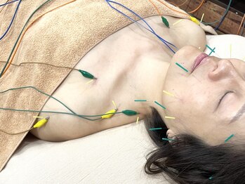 ビースタイル(B-style)の写真/【猫背/巻き肩/首肩こり/くいしばり】電気美容鍼×電気肩こり鍼で悩み解消!貴方に向き合う施術と熟練技が◎