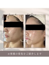 肌イズム つくば店(肌ism)/ララピール+LDM+ヒト幹P5回目